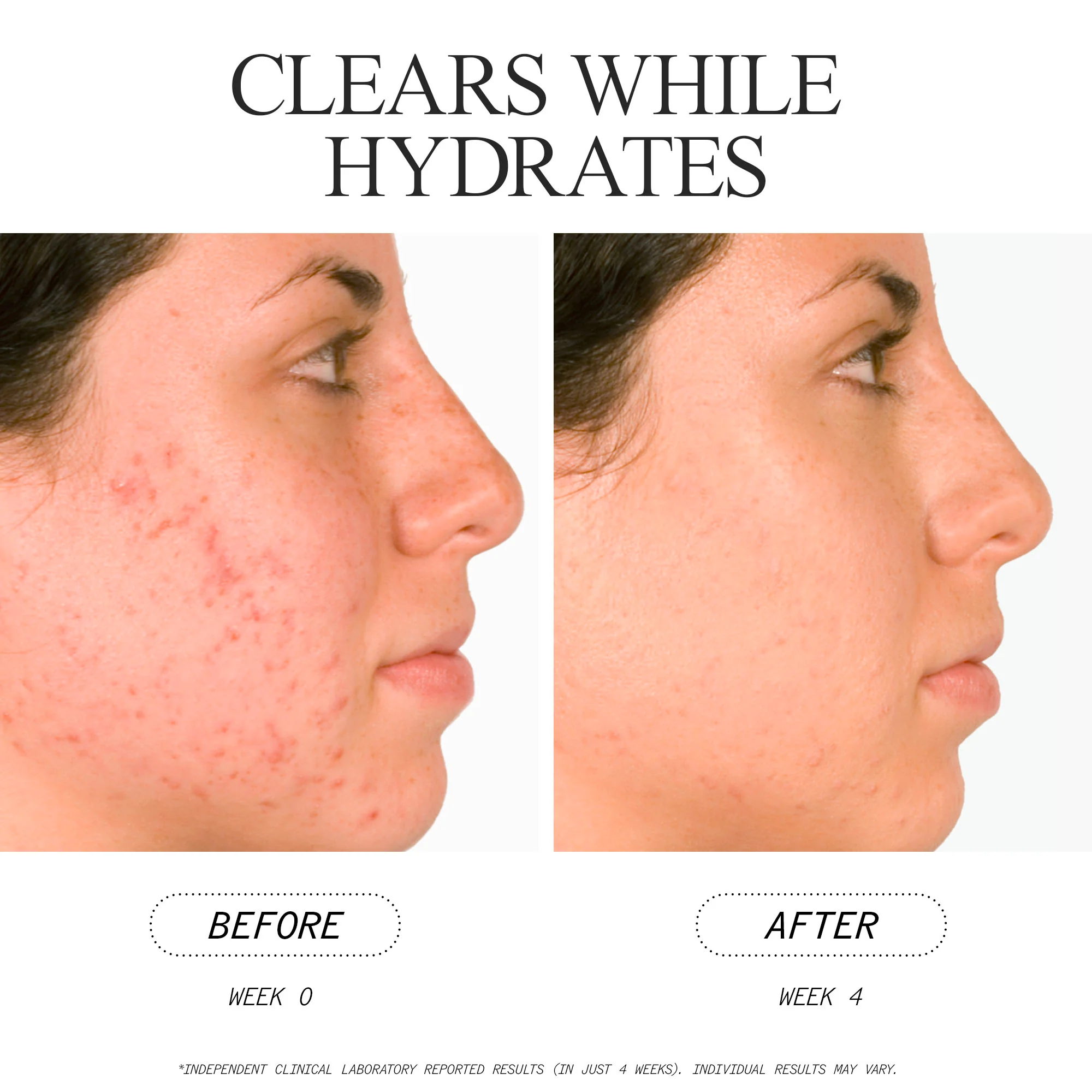 Salicylic Acid Acne Serum - Image 4