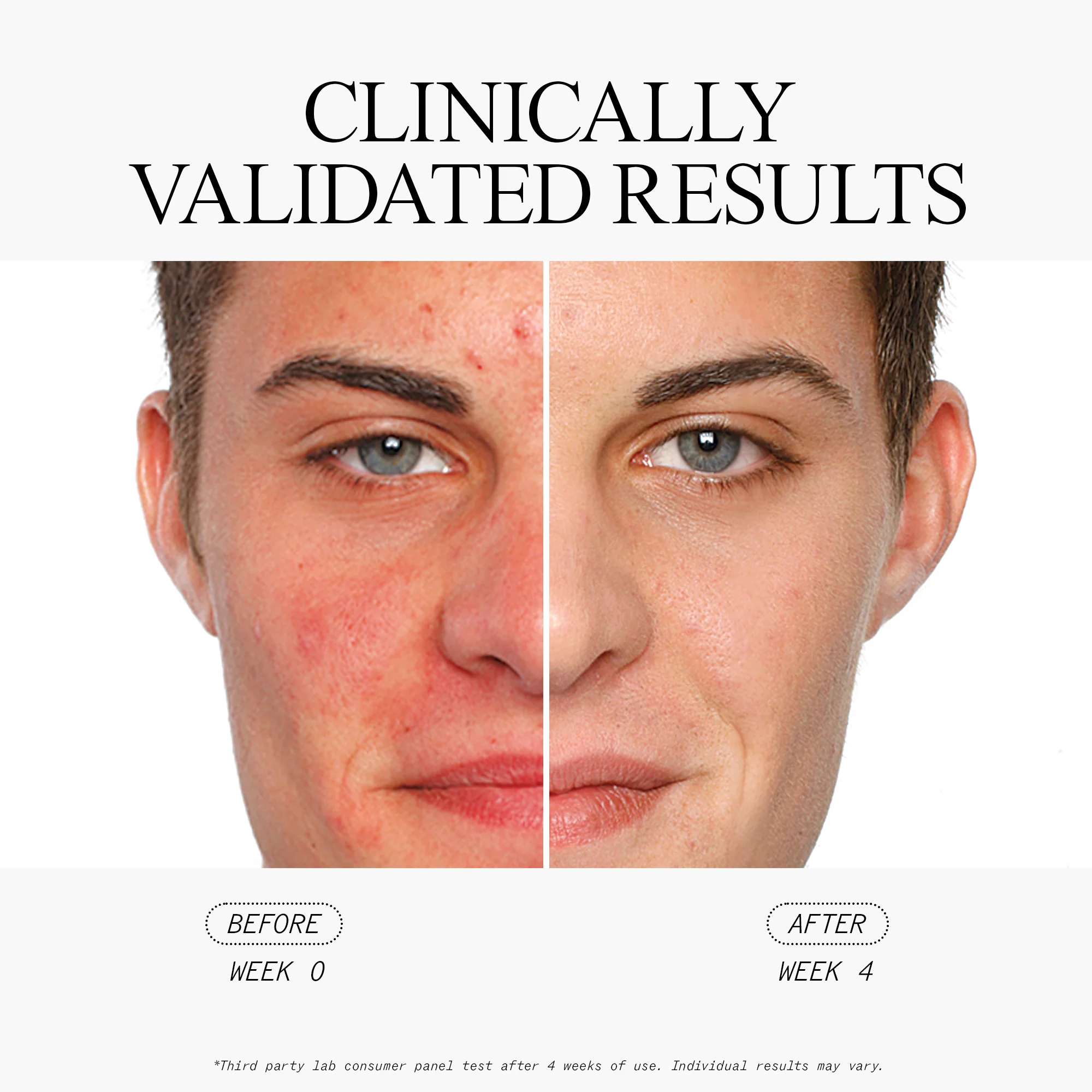 Salicylic Acid Acne Serum - Image 5